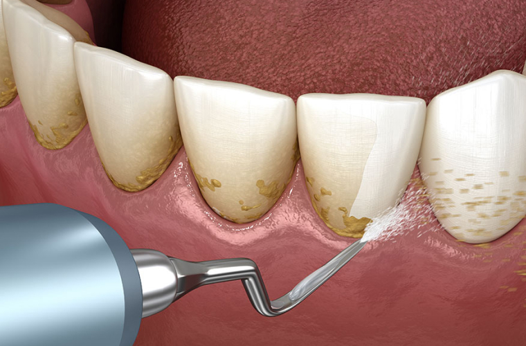 Что такое зубной налёт и как с ним справиться