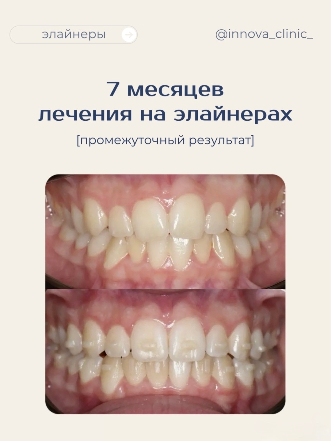 7 месяцев лечения на элайнерах, промежуточный результат