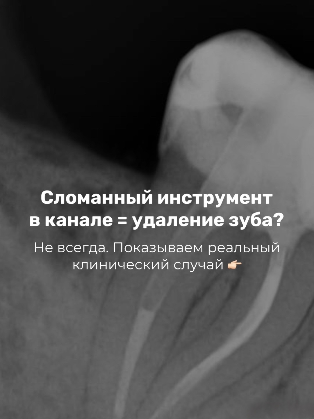 Сломанный инструмент в корневом канале = удаление зуба?