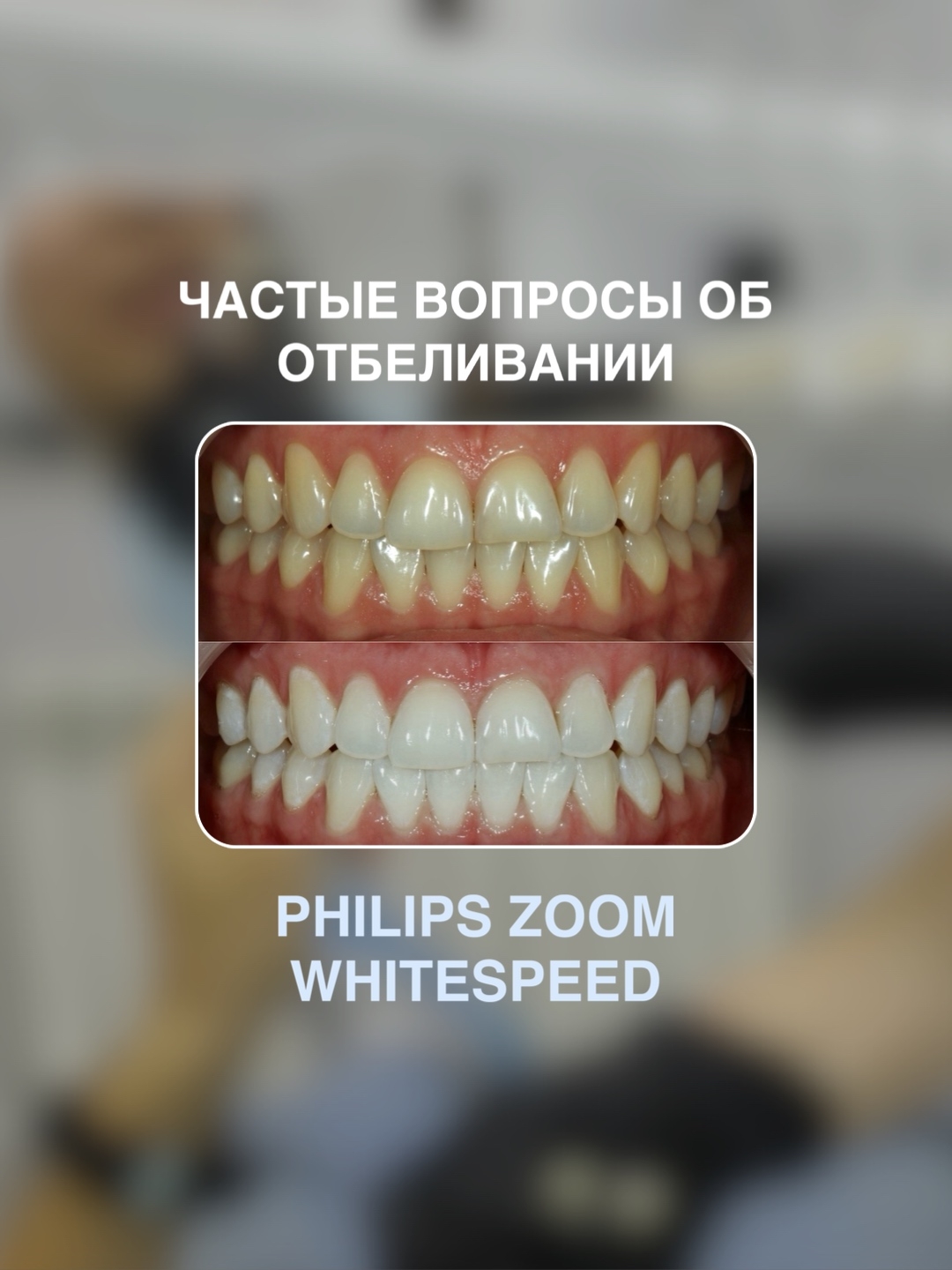 Частые вопросы об отбеливании
