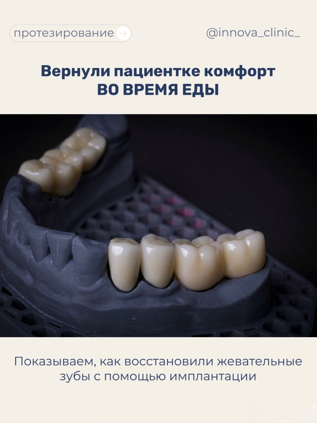 Показываем, как восстановили жевательные зубы с помощью имплантации