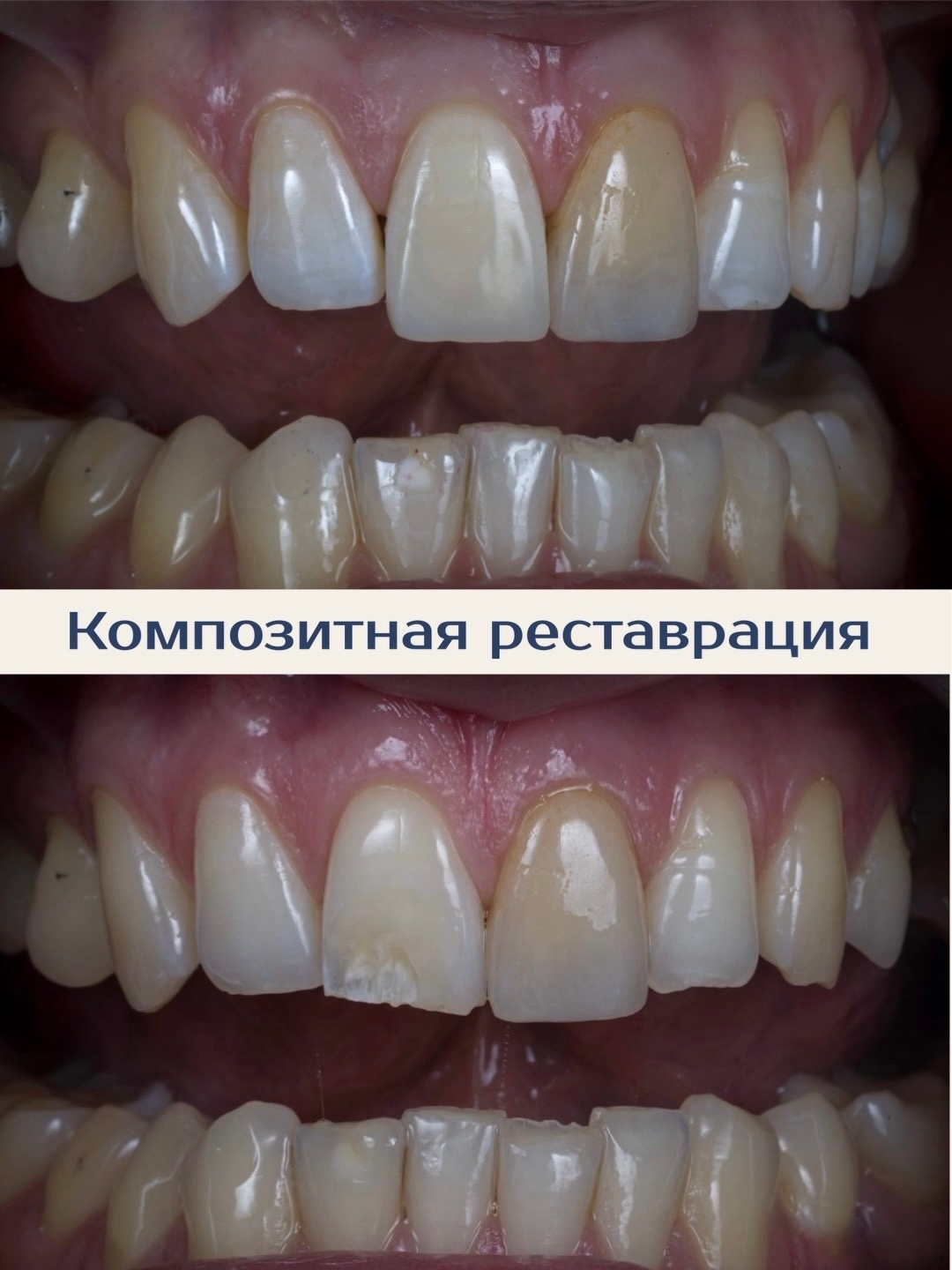 Скол переднего зуба: восстановили форму и эстетику