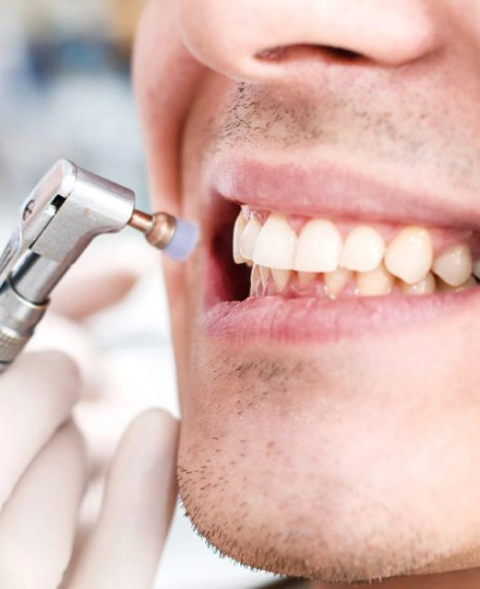 Скидка 20% на гигиену для пациентов