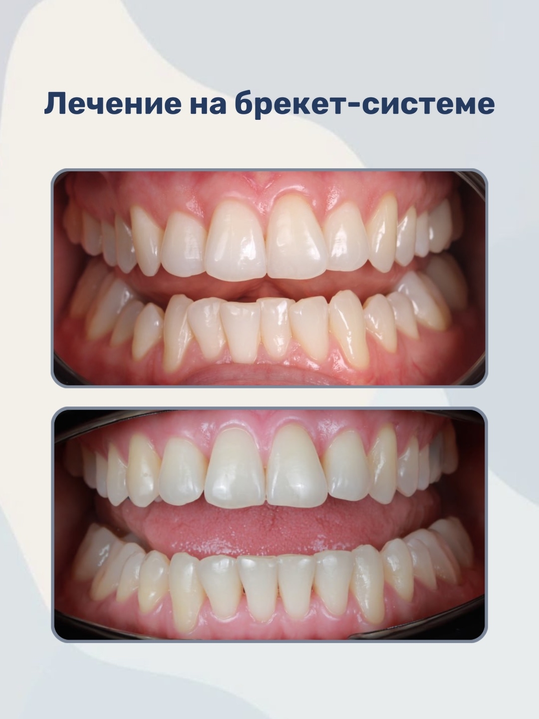 Комплексное лечение на брекет-системе