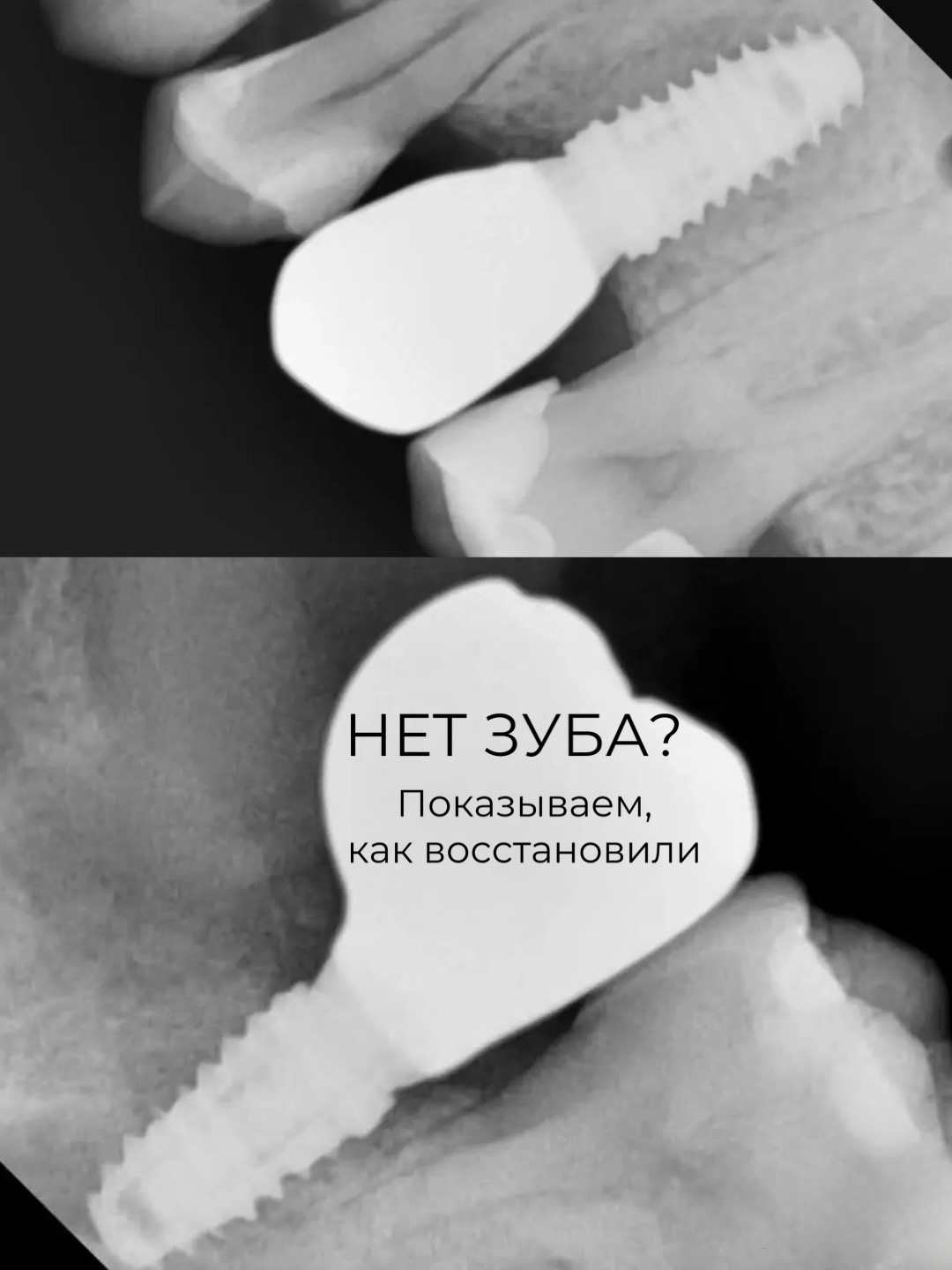 Потеря одного зуба — незаметная проблема только на первый взгляд