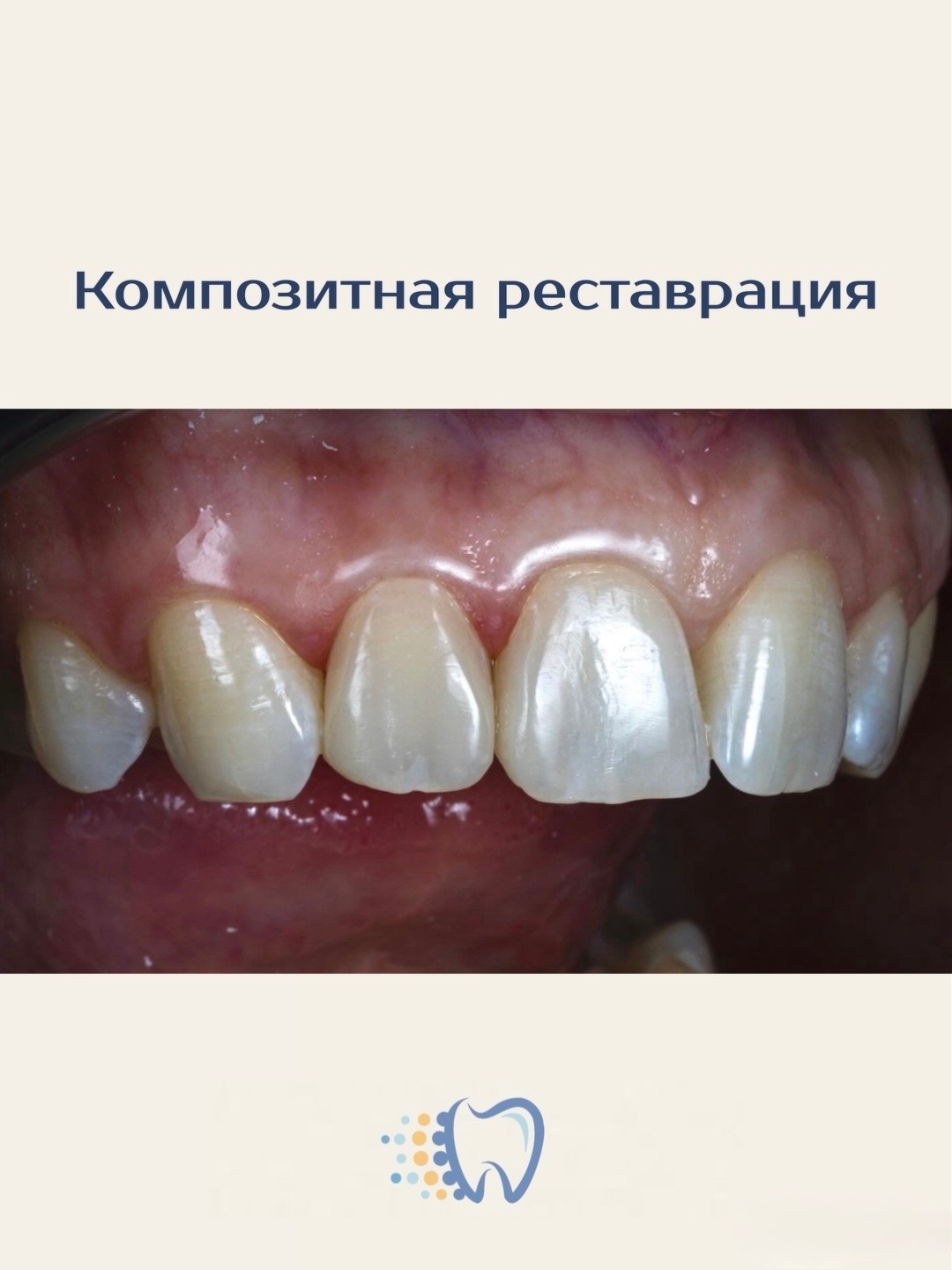 Композитная реставрация