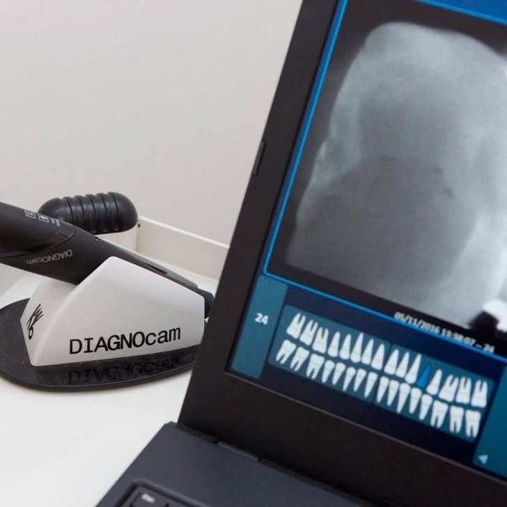 Как распознать скрытый кариозный процесс