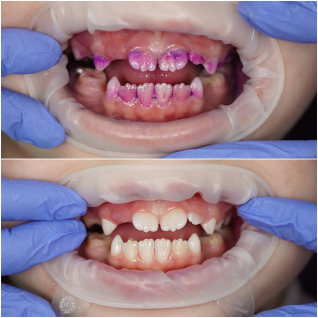 Профессиональная гигиена полости рта у детей