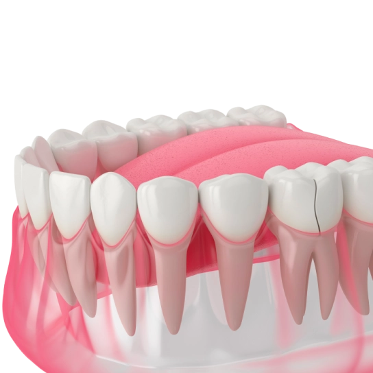 Реставрация зубов фото