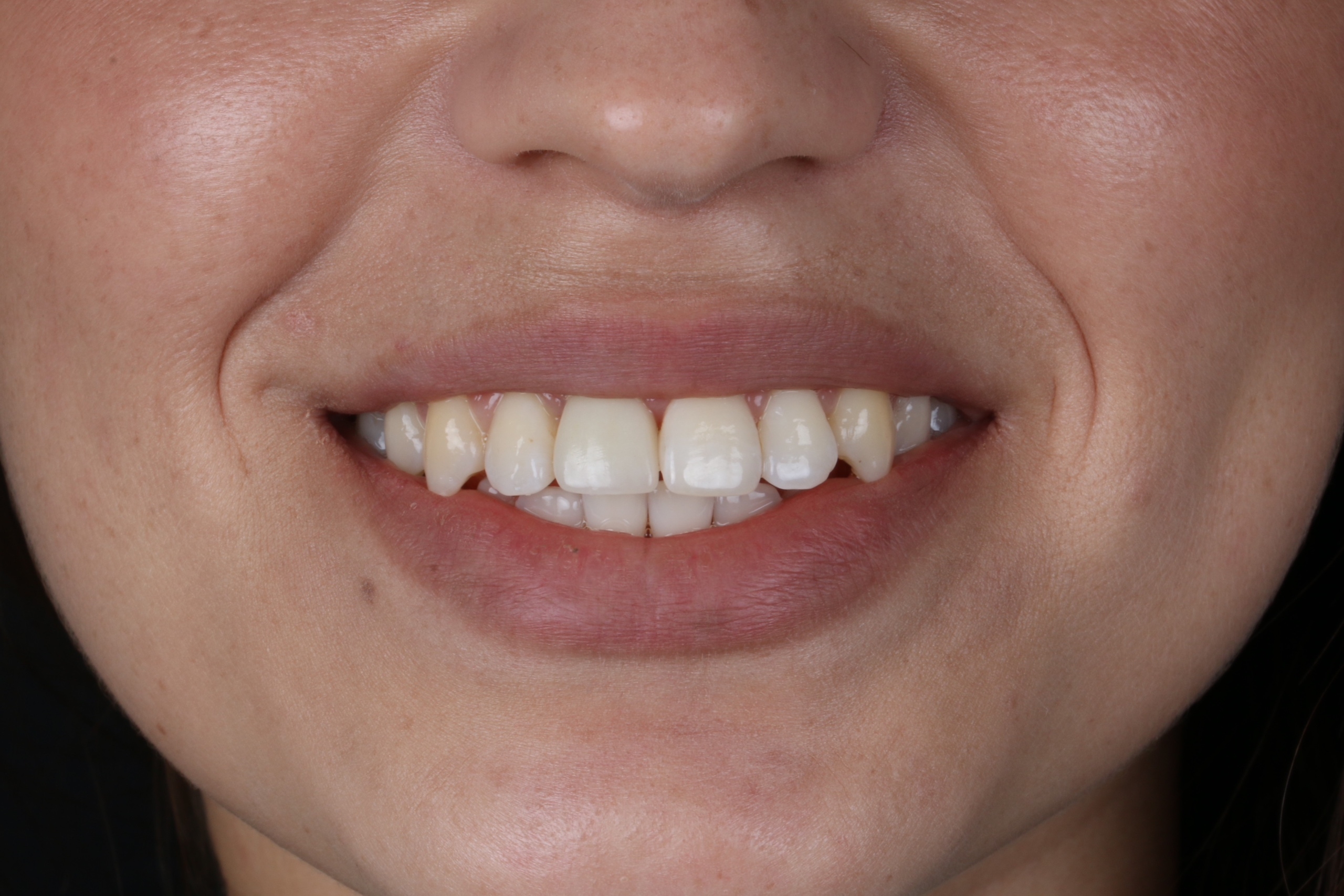 Когда устанавливать имплант после удаления зуба