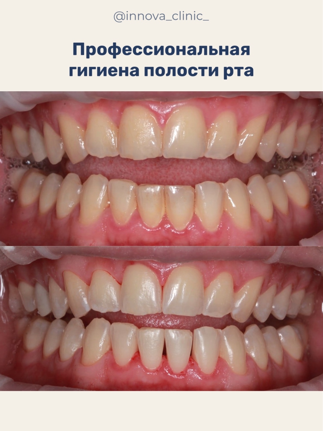 Регулярная профессиональная гигиена помогает поддерживать не только чистоту зубов, но и здоровье дёсен