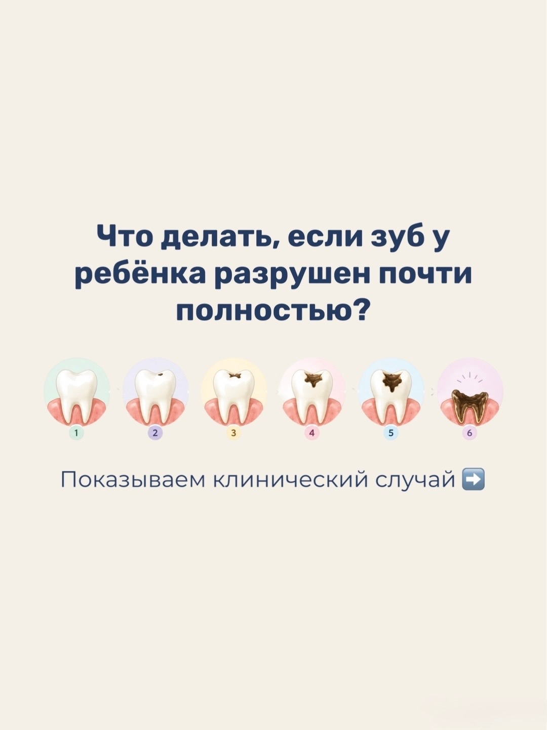 Что делать если зуб у ребенка разрушен почти полностью?