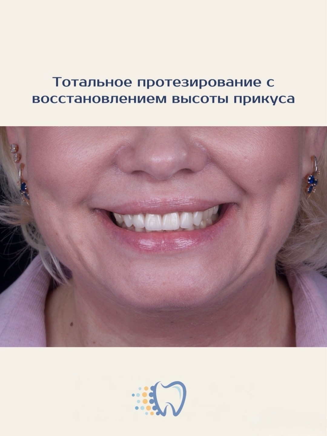 Тотальное протезирование с восстановлением высоты прикуса