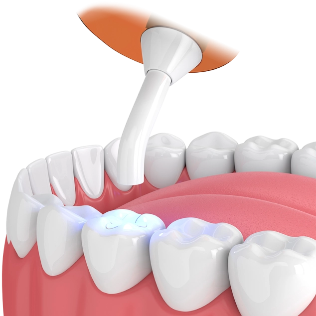 Герметизация фиссур фото