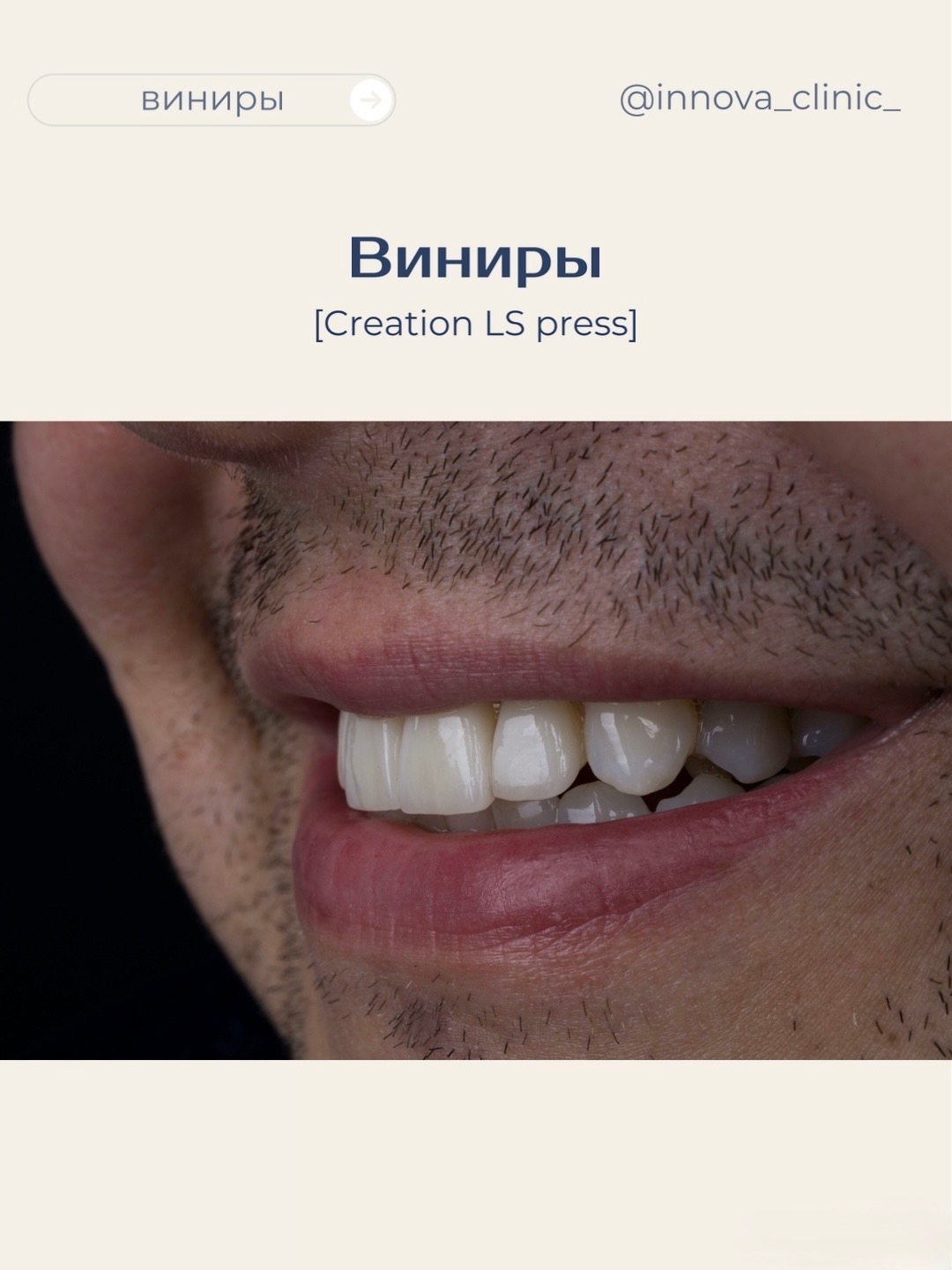 Как получить красивую улыбку, сохранив натуральность
