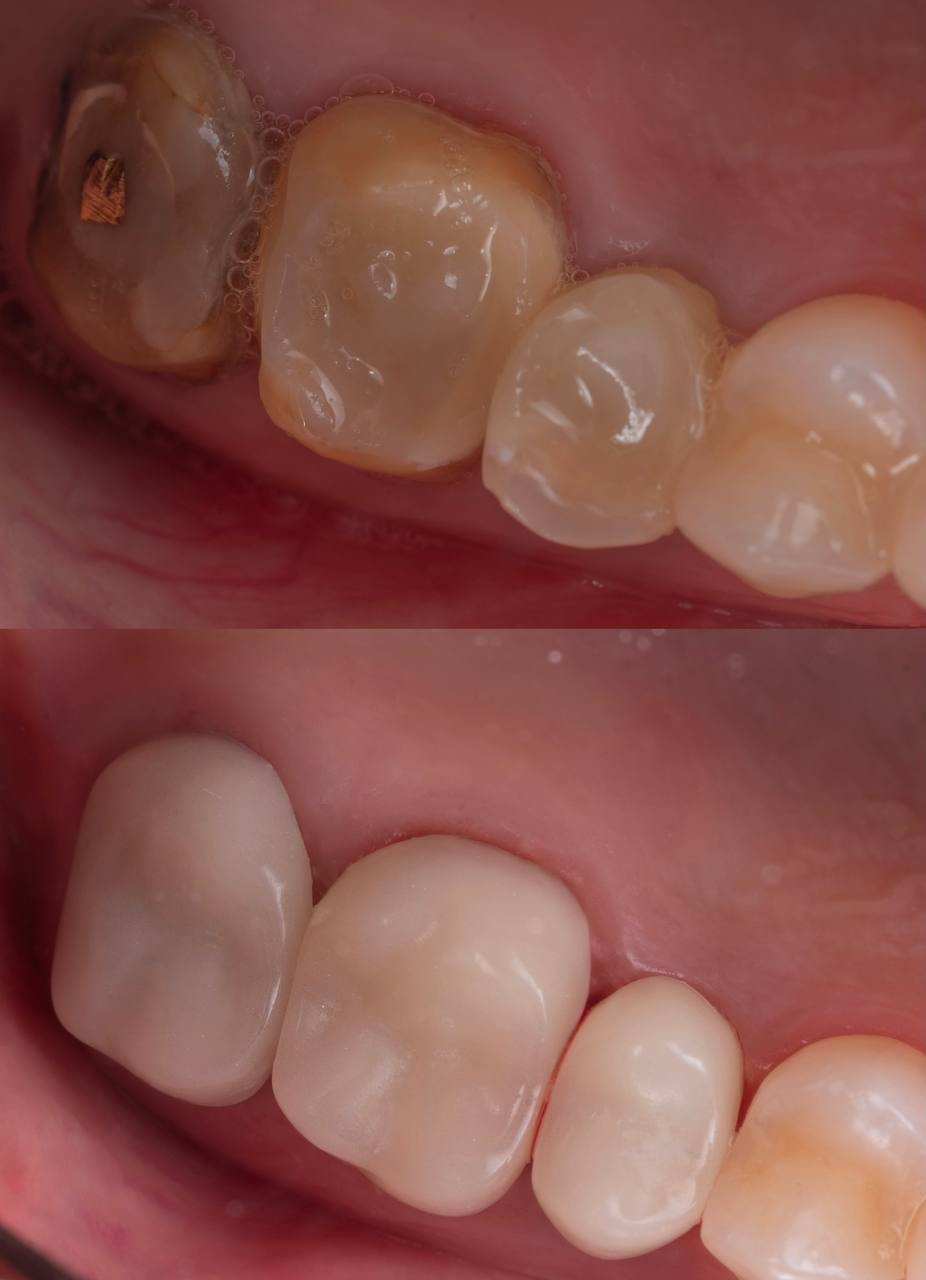 Установка временных коронок на длительный срок