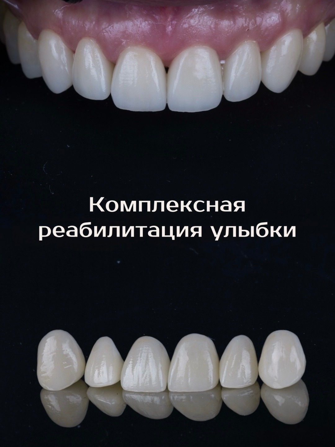 Комплексная реабилитация улыбки