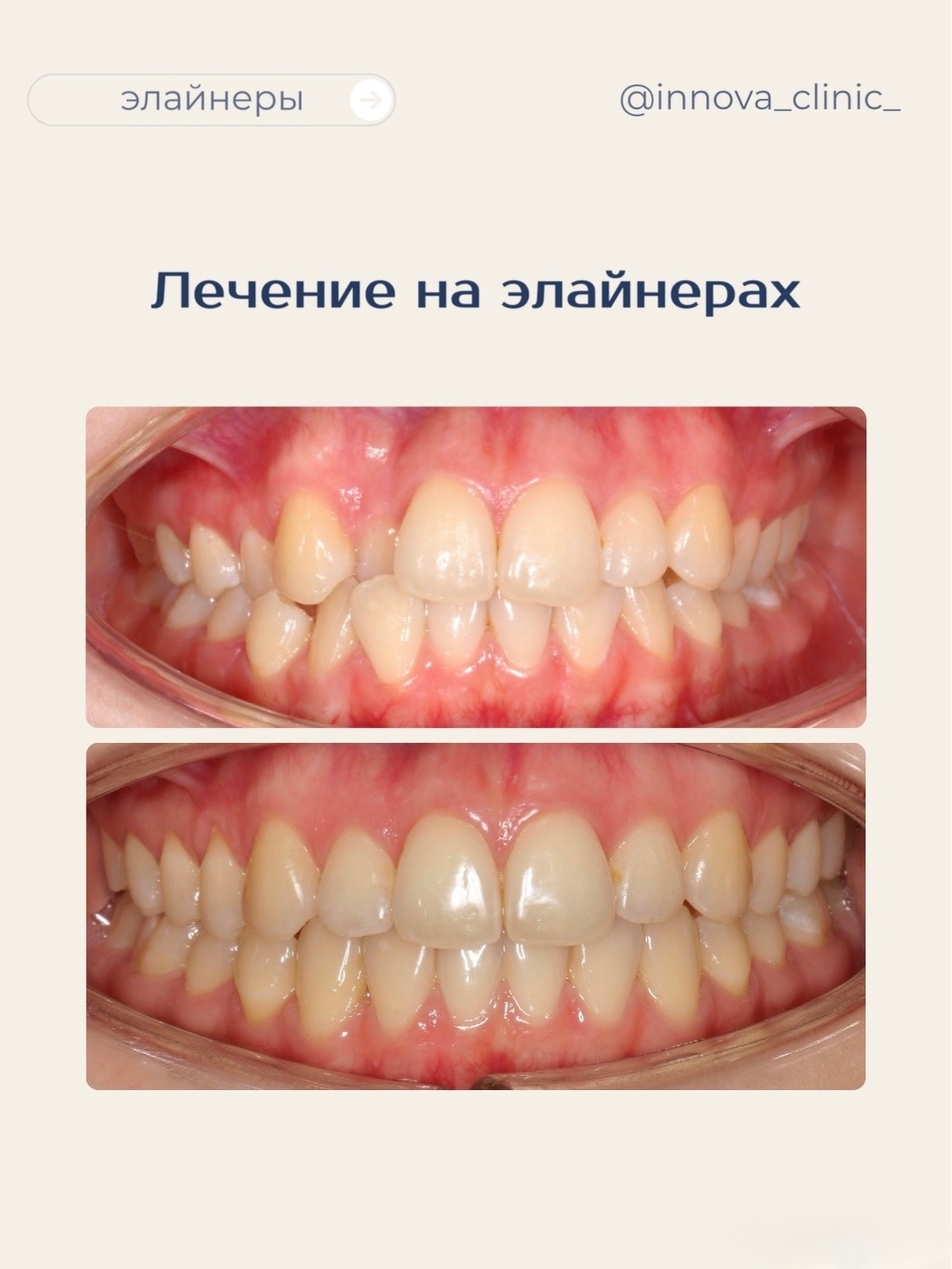 Результат лечения на элайнерах