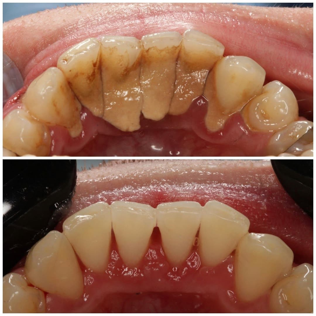 Разрушительный миф о зубном камне: он не защищает, а вредит!