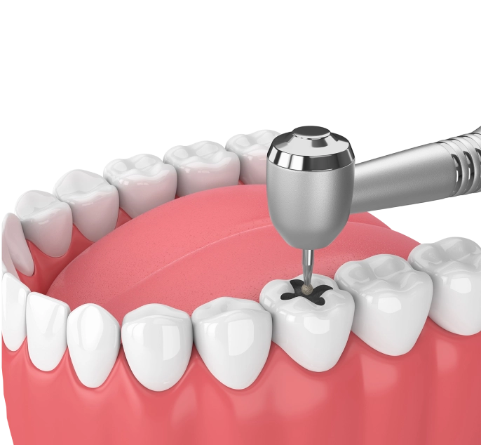 Лечение зубов фото
