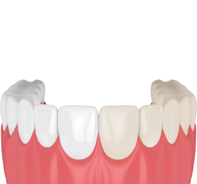 Профессиональное отбеливание фото