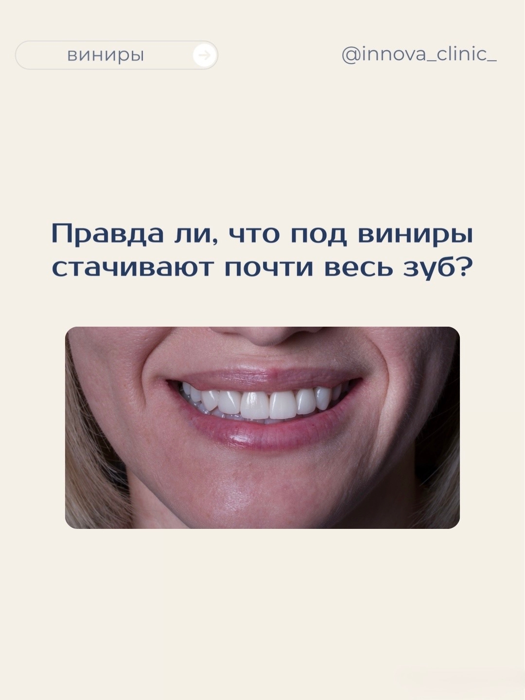 Идеальная улыбка с винирами