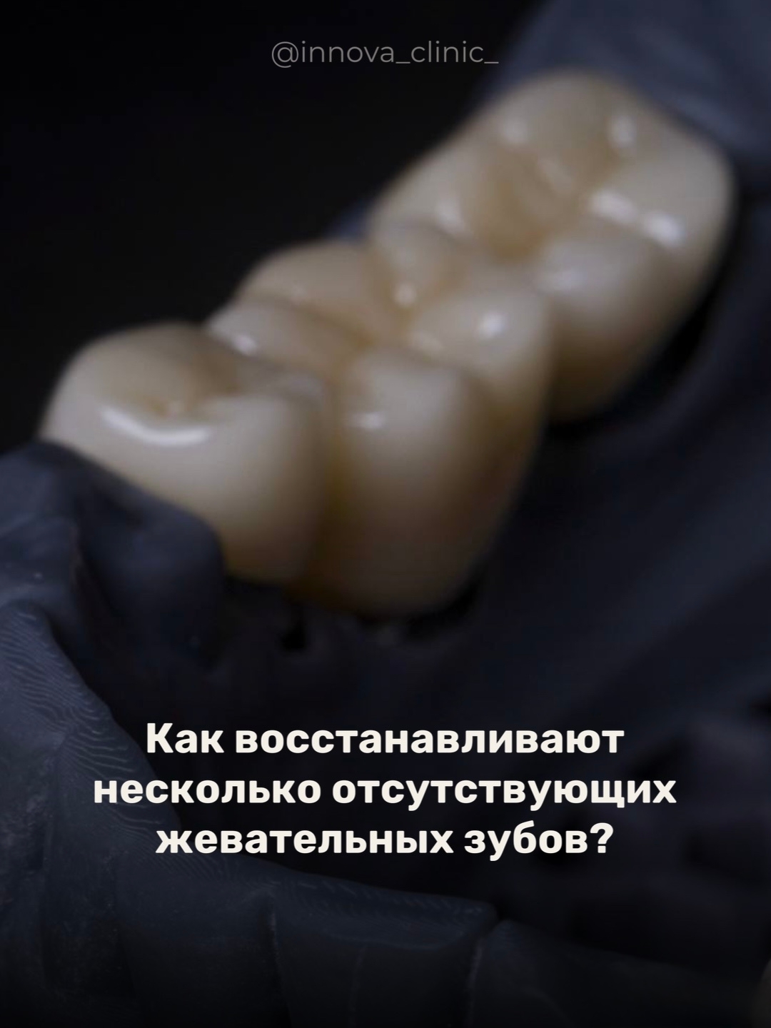 Как восстанавливают несколько отсутствующих жевательных зубов?