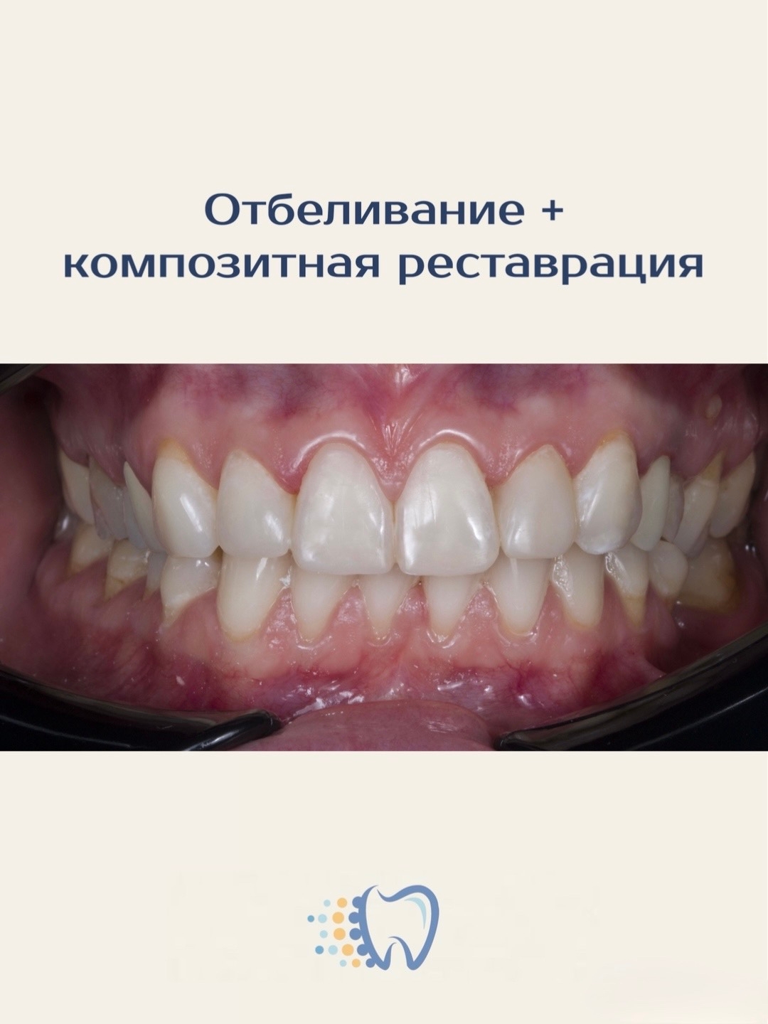 Потемневшие зубы, сколы или неровный край можно аккуратно и естественно исправить