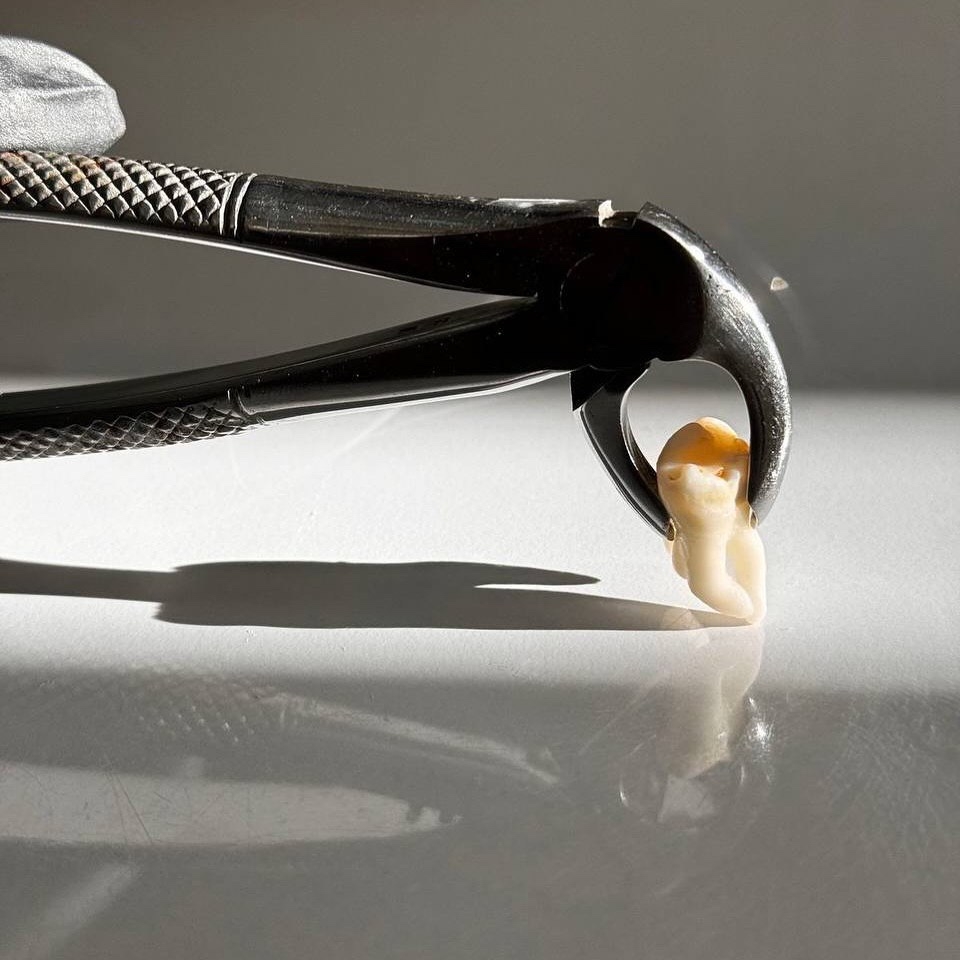 Можно ли удалить все зубы мудрости одновременно?