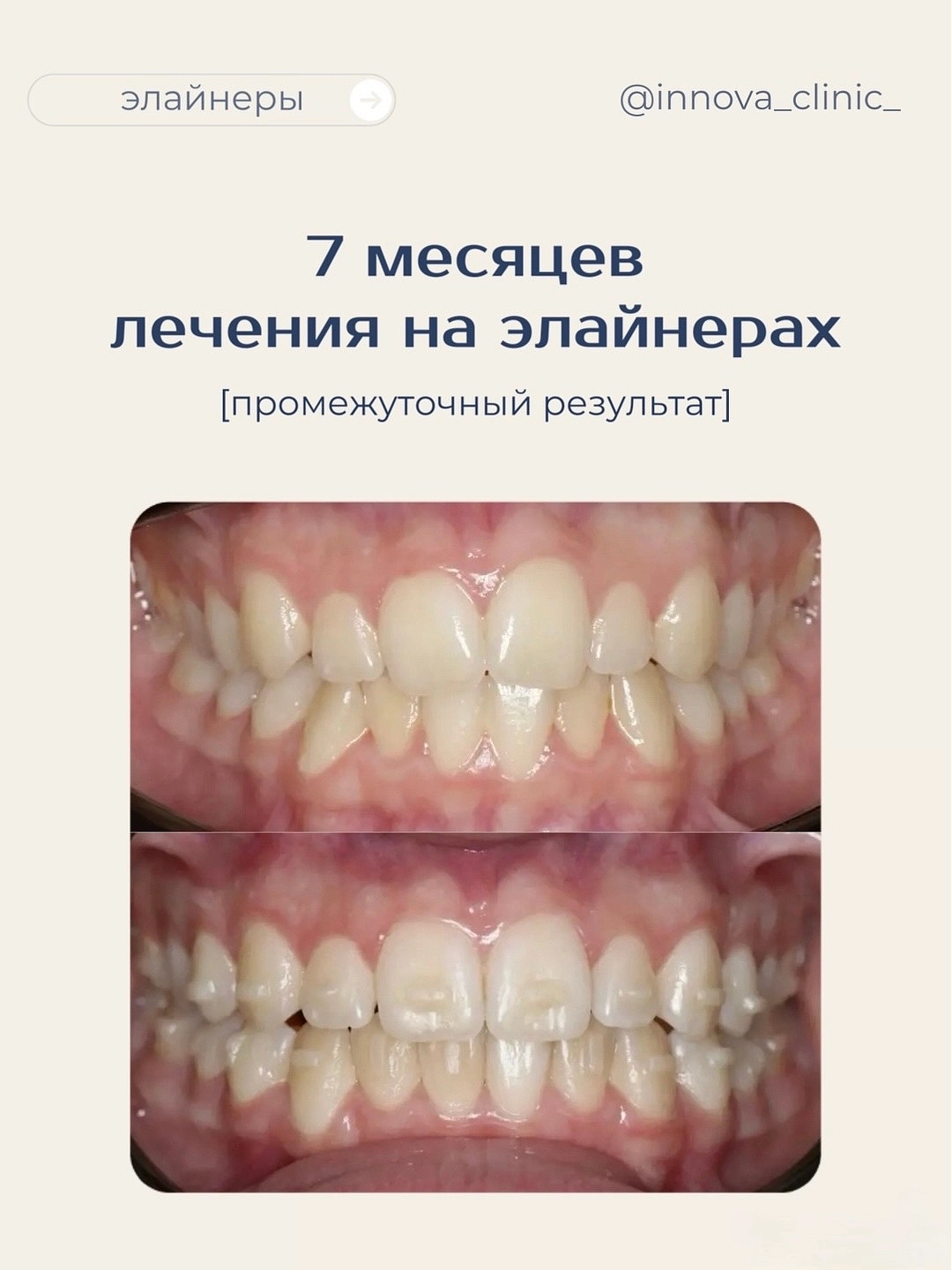 7 месяцев лечения на элайнерах, промежуточный результат