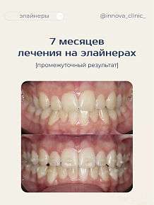 7 месяцев лечения на элайнерах, промежуточный результат