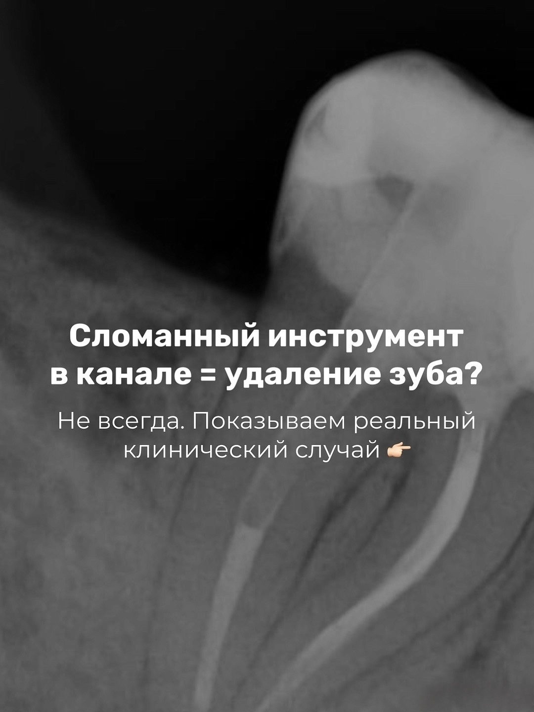 Сломанный инструмент в корневом канале = удаление зуба?