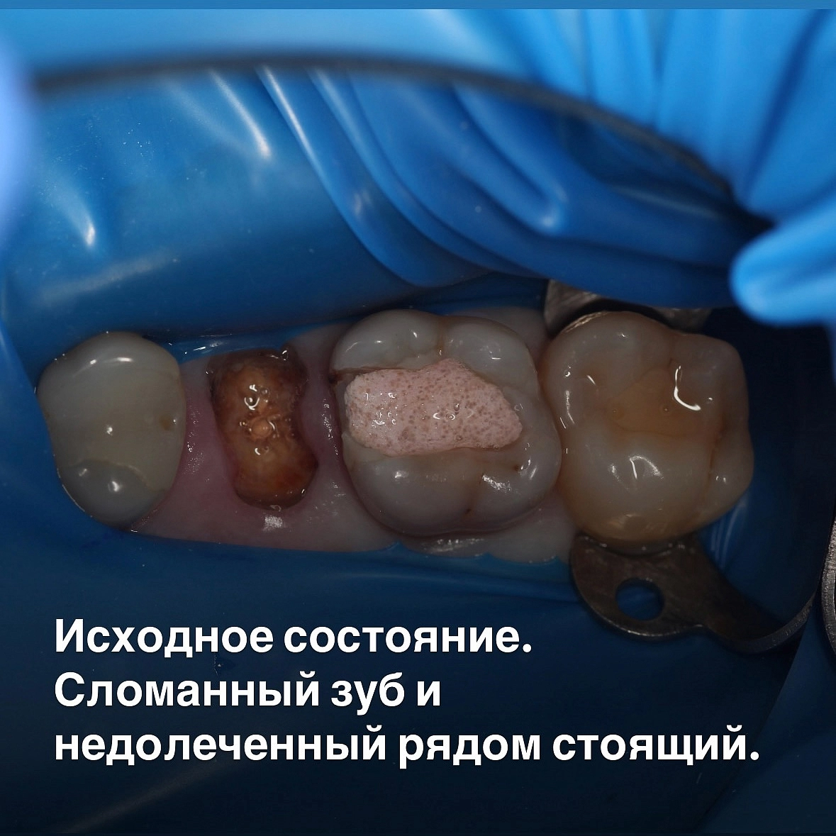 Сложный случай эндодонтического лечения: Спасение зуба!