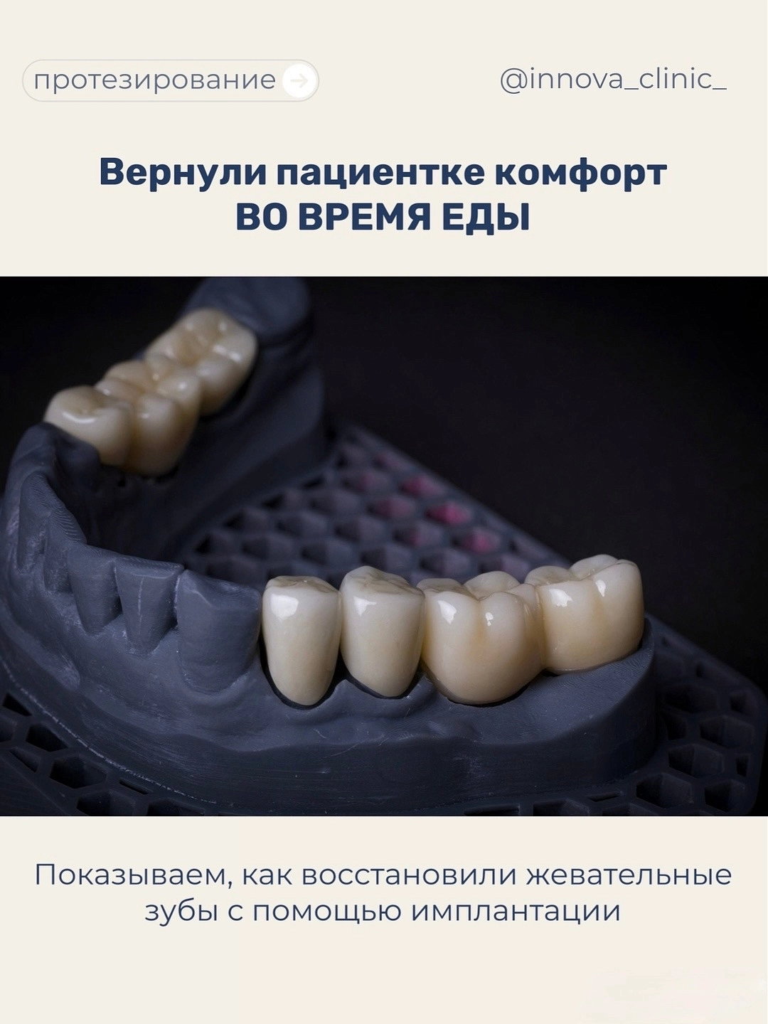 Показываем, как восстановили жевательные зубы с помощью имплантации