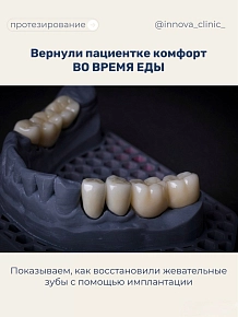 Показываем, как восстановили жевательные зубы с помощью имплантации