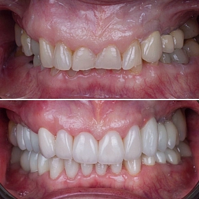 Клинический случай: Тотальное восстановление зубов