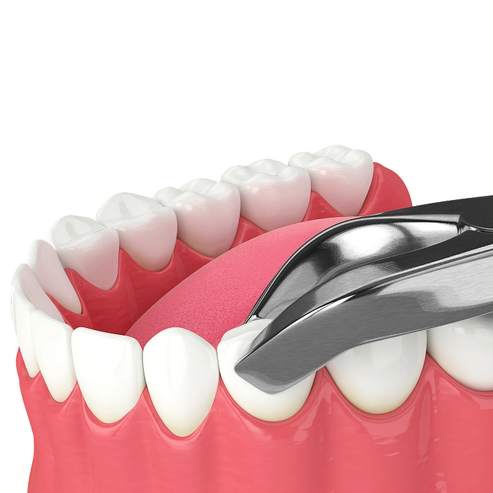 Удаление молочных зубов фото