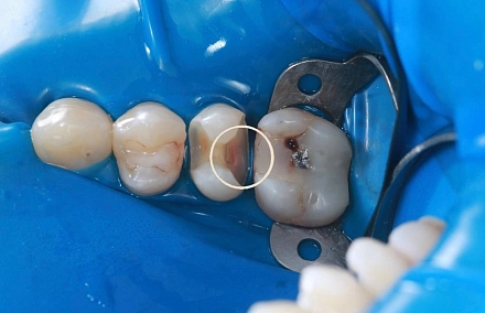 Восстановление сильно разрушенного зуба световым композитным материалом