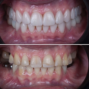 Тотальное восстановление зубов