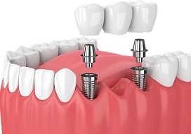 Имплантация фото