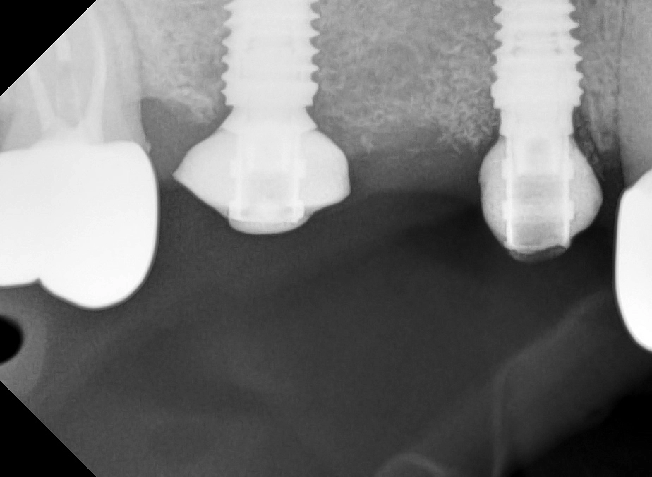  Всегда ли отсутствие костной ткани является противопоказанием к имплантации зубов?