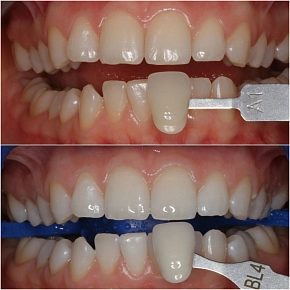 После отбеливания