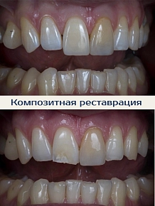 Скол переднего зуба: восстановили форму и эстетику
