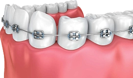 Установка брекетов фото