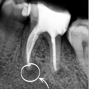 Кровоточивость десен