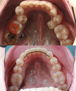 Сколько нужно носить брекеты?