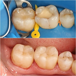 Основной принцип лечения кариозных полостей