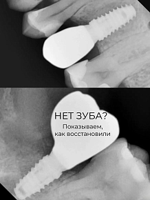 Потеря одного зуба — незаметная проблема только на первый взгляд