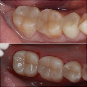 Безметалловая керамика