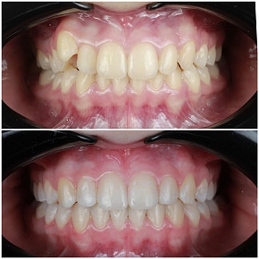 Брекеты: Больно ли их носить?